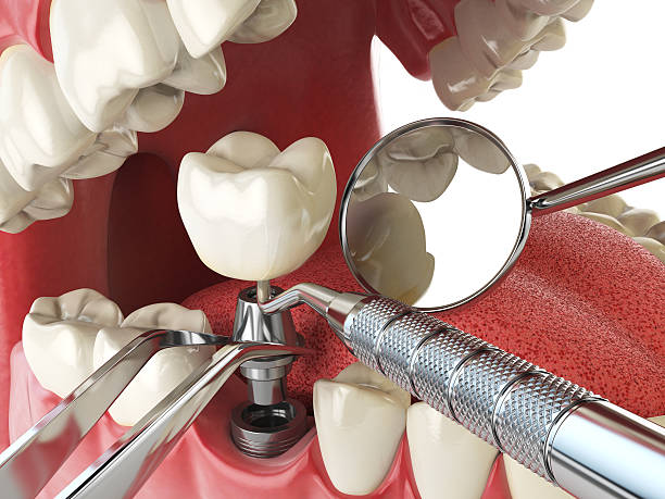 Best Emergency Wisdom Teeth Removal in Diamond Bar, CA